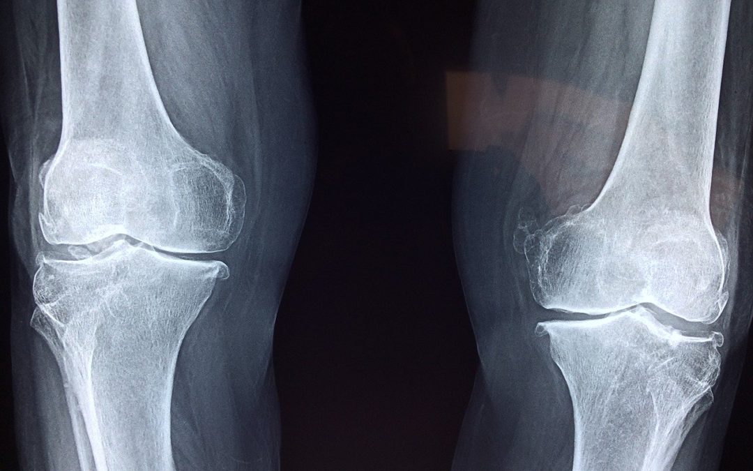 How Long Does It Take to Build Bone Density?