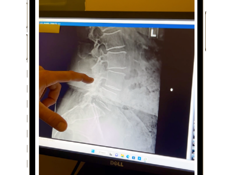 Spondylolisthesis and why x-rays are key to chiropractic care.