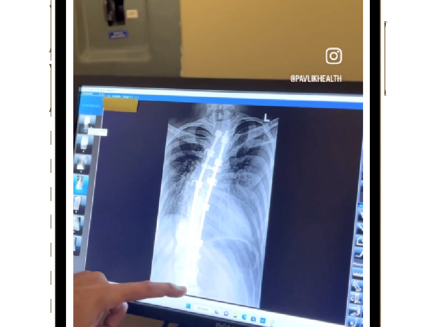 Are there Chiropractic treatments to help with Scoliosis?